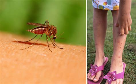 hur får man myggbett att försvinna